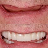 Before and after dental implants with sedation at BMC Dental Klinik, restored smile result