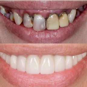 Vorher-nachher-Ergebnis der Zahnbehandlung mit Sedierung in der BMC Dental Klinik