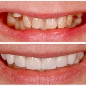 Before and after dental veneers at BMC Dental Klinik, smile transformation result