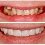 Before and after dental veneers at BMC Dental Klinik, smile transformation result