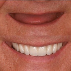 Before and after dental implants result at BMC Dental Klinik, restored smile transformation