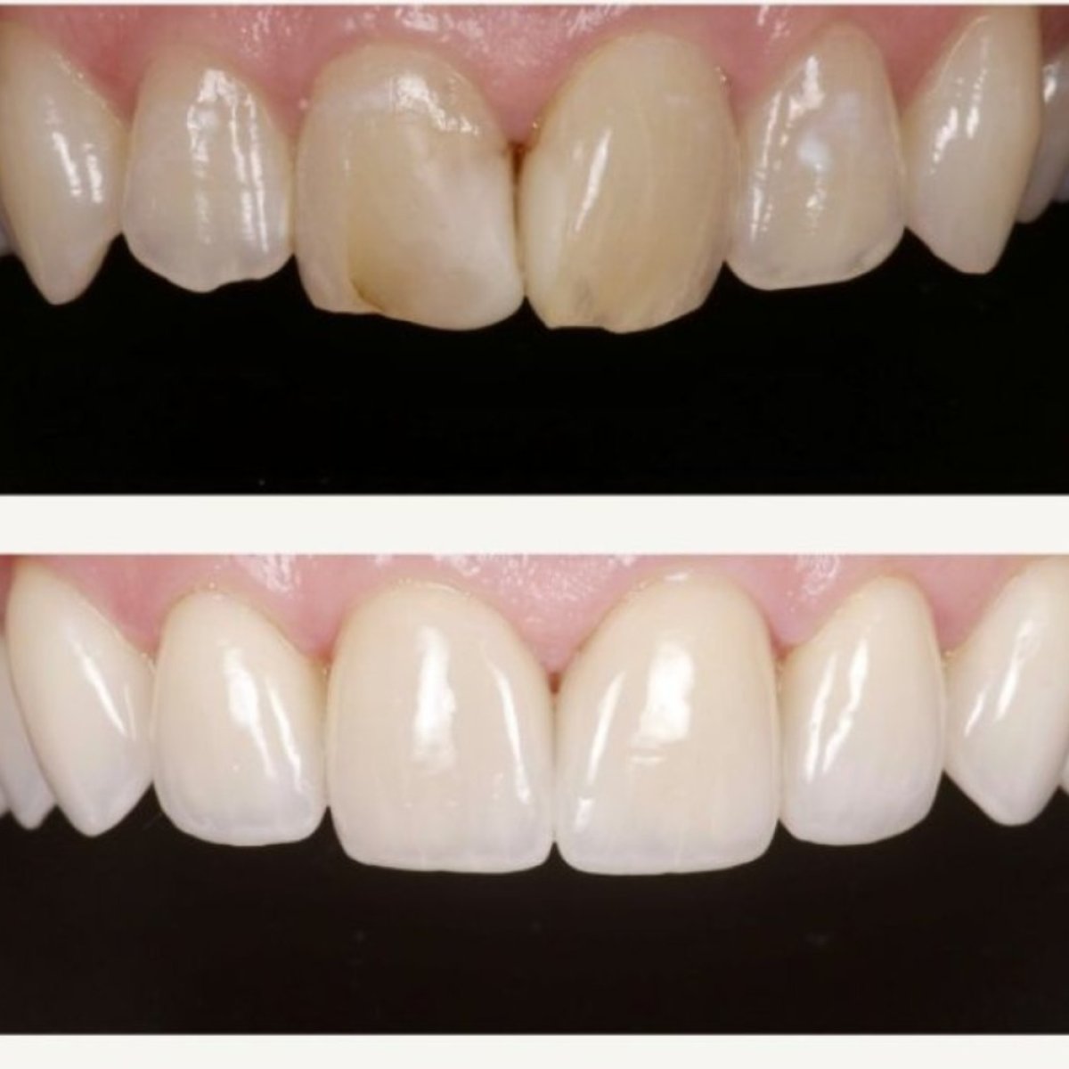 نتائج قبل وبعد عدسات الأسنان في BMC Dental Klinik، ابتسامة طبيعية