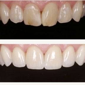 Before and after dental veneers at BMC Dental Klinik, smile makeover with natural results