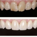 Before and after dental veneers at BMC Dental Klinik, smile makeover with natural results