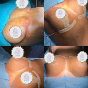 Breast augmentation before and after results at Dr. MED clinic, enhanced breast contour visible