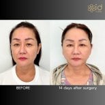 Facelift Vorher-Nachher-Ergebnisse bei ID Clinic Bangkok, sichtbare Verjüngung nach 14 Tagen