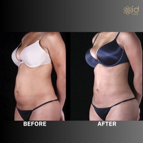 before-after photo bodytite-body-contouring