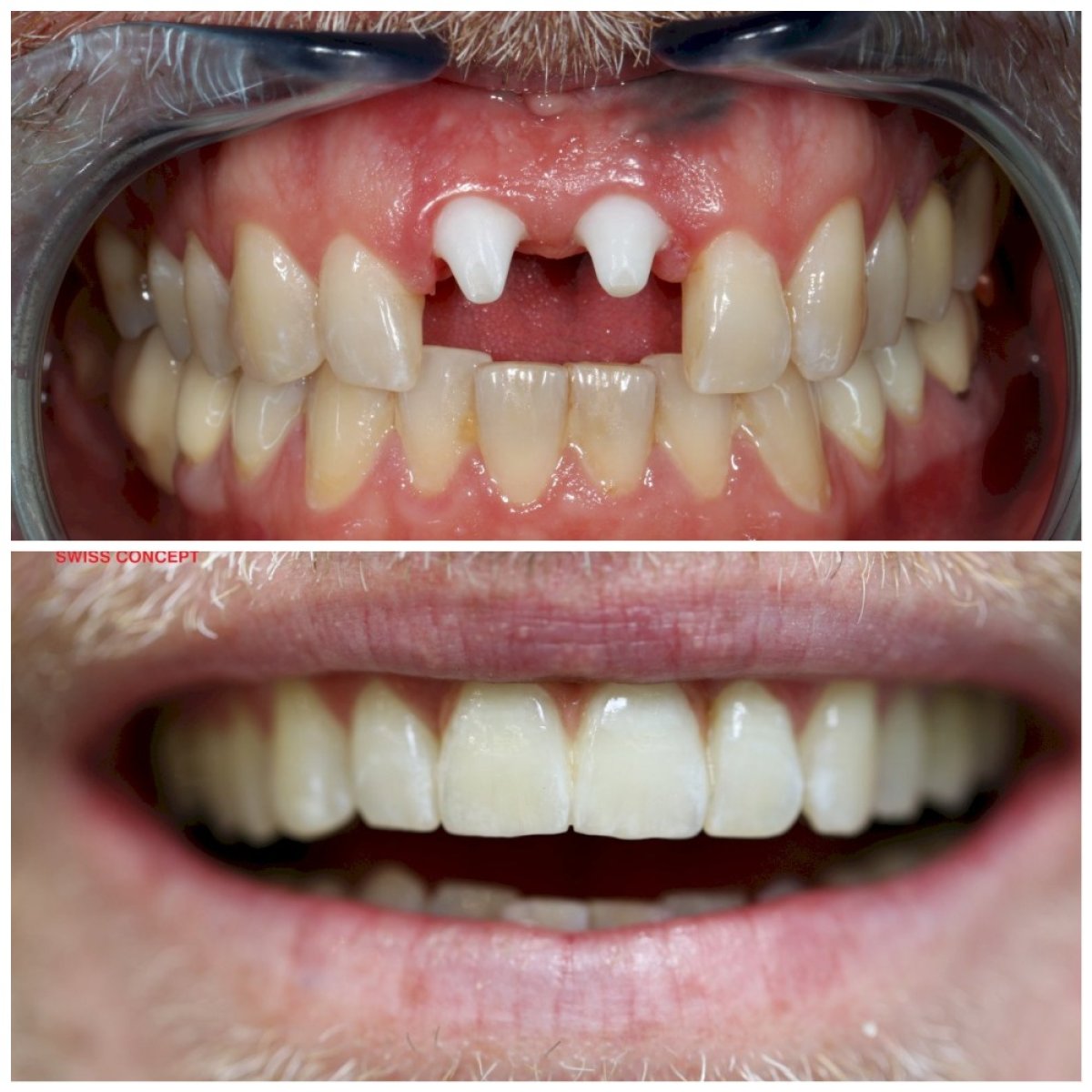Resultados de implantes dentales antes y después en Bio Clinic, restauración de dientes frontales