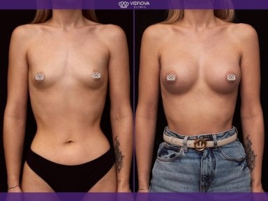 Результаты маммопластики до и после в клинике Vidnova – видимое увеличение груди