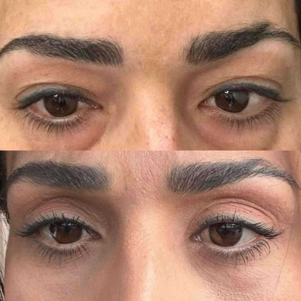 Resultados de blefaroplastia superior antes y después en Soraca Med Istanbul, área rejuvenecida