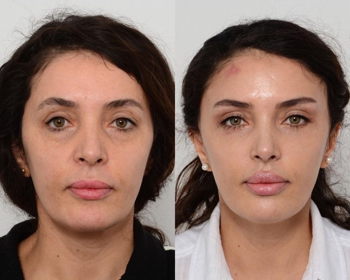 Resultados antes y después de lifting facial deep plane en Memorial Şişli Hospital, rejuvenecimiento