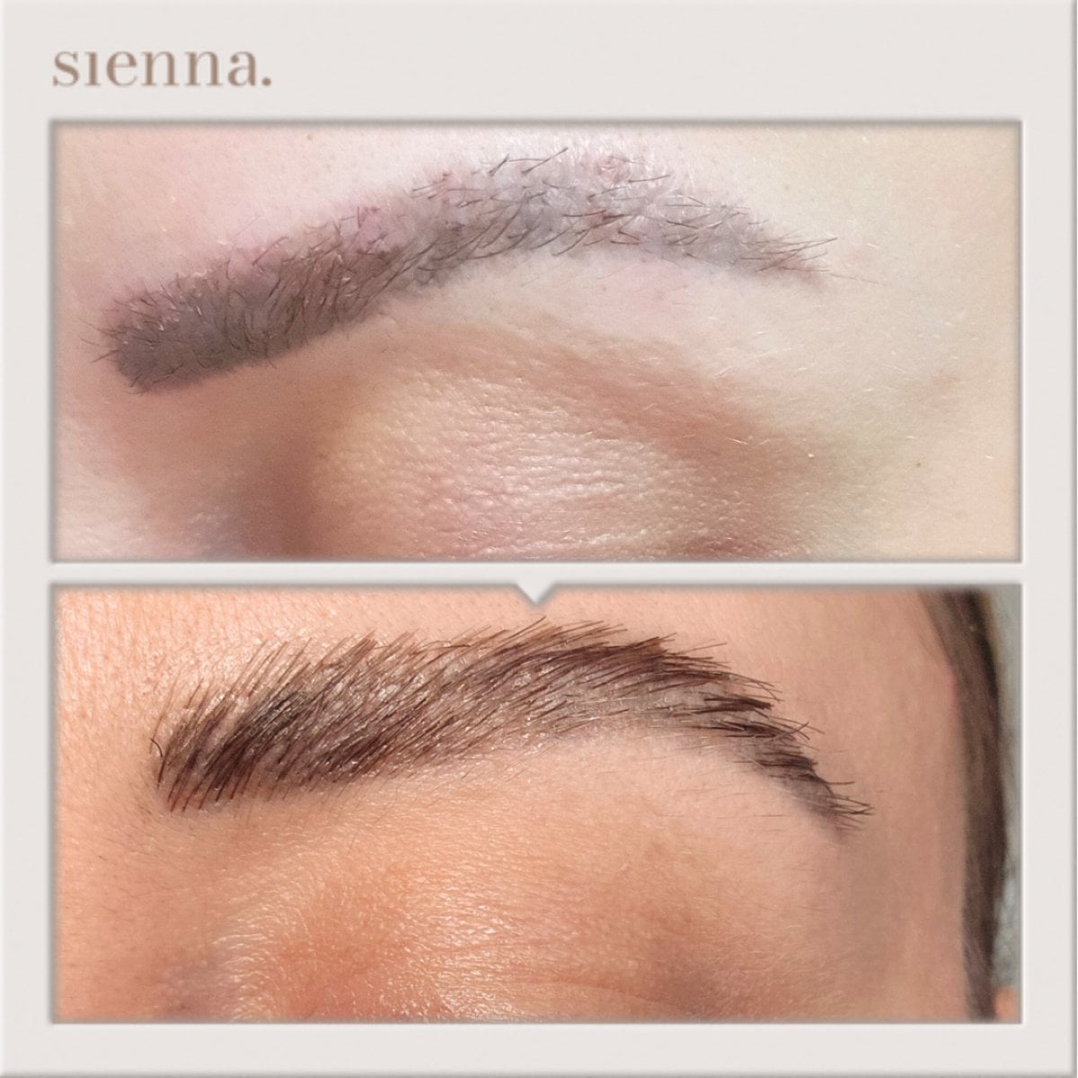 Resultados de trasplante de cejas antes y después en Sienna Clinic – cejas más densas y naturales