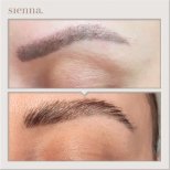 Before and after eyebrow transplantation results at Sienna Clinic – fuller, natural brows