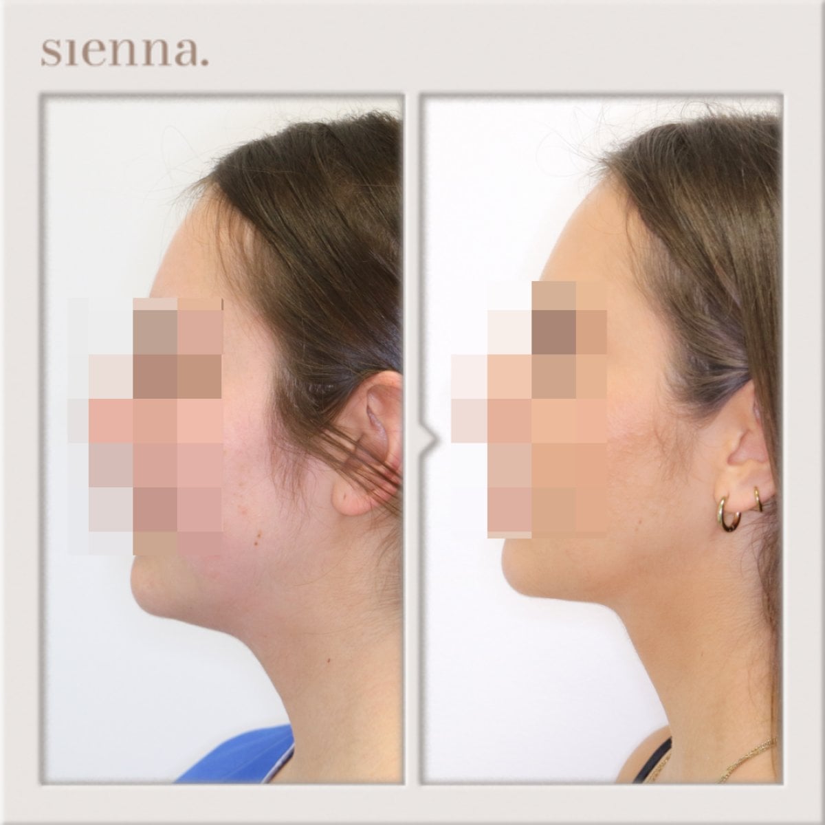 نتائج شفط الدهون قبل وبعد في Sienna Clinic، تحسين خط الفك وتحديد الرقبة