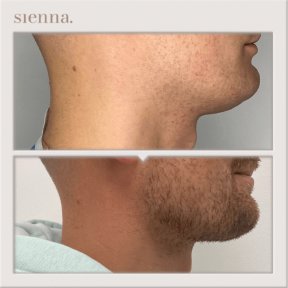 Before and after liposuction results at Sienna Clinic, improved jawline and neck contour