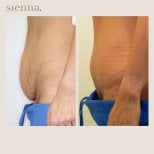Résultats avant et après abdominoplastie à Sienna Clinic, amélioration du contour abdominal