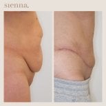 Before and after tummy tuck results at Sienna Clinic, visible abdominal contour improvement