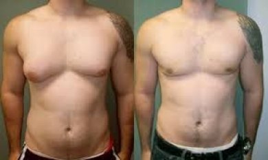 before-after photo gynecomastia-surgery