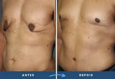 before-after photo gynecomastia-surgery