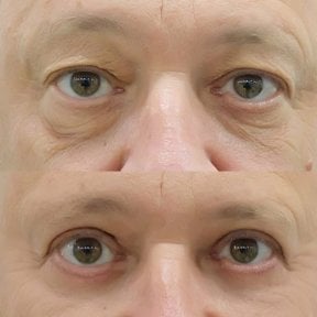 Résultats avant/après blépharoplastie des paupières inférieures à Somchai Clinic