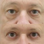 Résultats avant/après blépharoplastie des paupières inférieures à Somchai Clinic