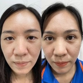 Résultats avant/après blépharoplastie des paupières inférieures à Somchai Clinic, poches réduites
