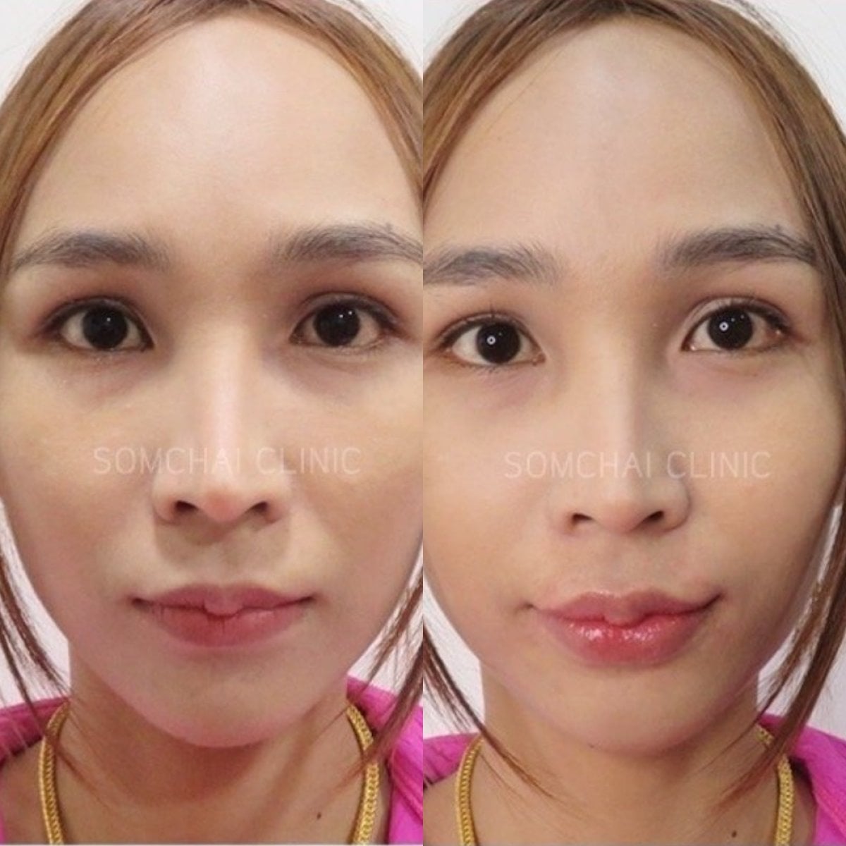 Resultados de feminización facial antes y después en Somchai Clinic, rasgos más suaves