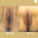 Vorher-nachher-Ergebnis narbenfreie Labioplastik bei ID Clinic Bangkok, verbesserte Optik