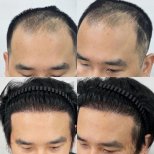 Vorher-nachher-Ergebnis Haartransplantation bei ID Clinic Bangkok – volle Haarlinie wiederhergestellt