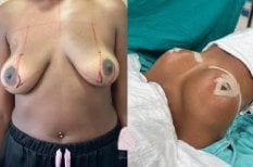 Before and after breast reduction results at Dr. MED clinic, visible lift and contour improvement