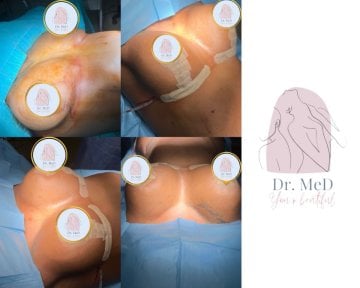 Breast reduction before and after results at Dr. MED, visible contour improvement post-surgery