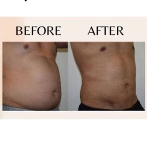 Liposuktion Vorher-nachher-Ergebnis bei ID Clinic Bangkok – sichtbare Bauchkontur-Verbesserung