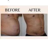 Liposuktion Vorher-nachher-Ergebnis bei ID Clinic Bangkok – sichtbare Bauchkontur-Verbesserung
