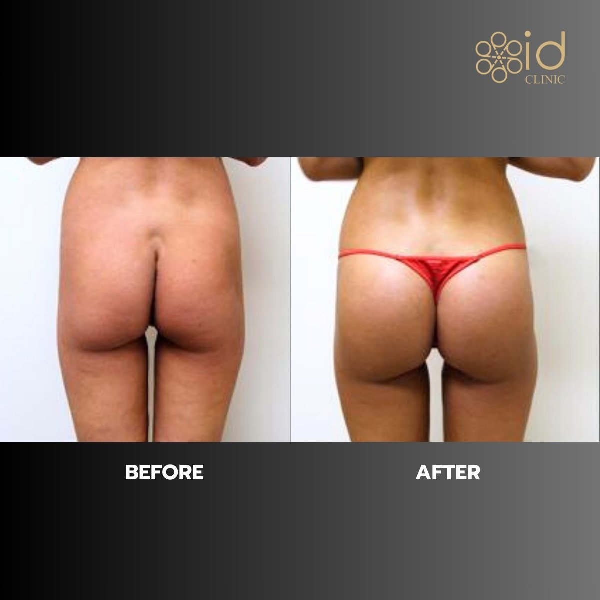 Antes y después de implantes de glúteos en ID Clinic Bangkok, mejora de forma y volumen