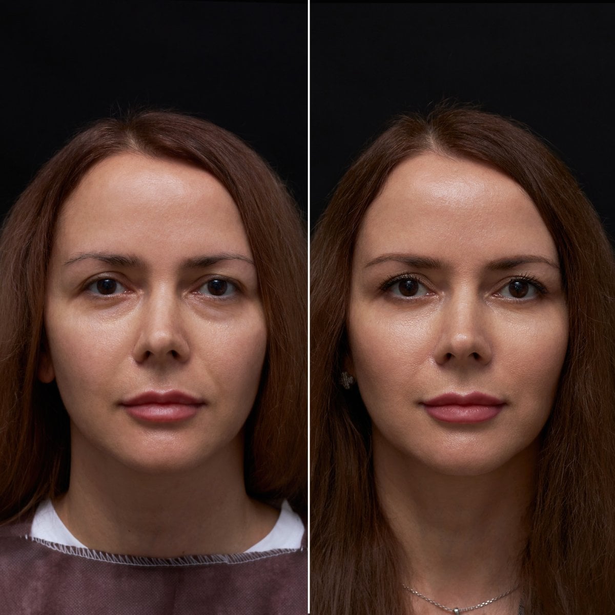 Resultados de blefaroplastia antes y después en Vidnova Clinic, corrección de párpados