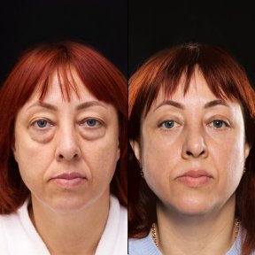 Vorher-nachher-Ergebnis der Blepharoplastik in der Vidnova Clinic – Lidkorrektur