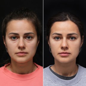 Vorher-nachher-Ergebnis der Blepharoplastik in der Vidnova Clinic, Lidkorrektur