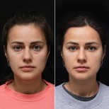 Vorher-nachher-Ergebnis der Blepharoplastik in der Vidnova Clinic, Lidkorrektur