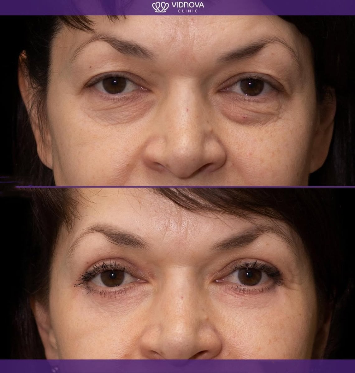 Resultados de blefaroplastia antes y después en Vidnova Clinic – corrección de párpados
