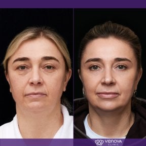 Результаты блефаропластики до и после в клинике Vidnova, коррекция век для омоложения