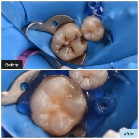 Before and after dental bonding results at Dental Clinic Dynasty Stomatology in Krakow