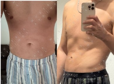 Before and after liposuction results at Dr. MED – improved male abdominal contour