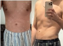 Before and after liposuction results at Dr. MED – improved male abdominal contour