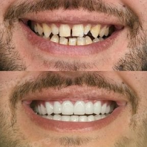 Vorher-nachher-Ergebnis No-Prep-Veneers bei Memorial Şişli Hospital, verbesserte Ästhetik
