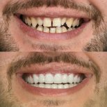 Vorher-nachher-Ergebnis No-Prep-Veneers bei Memorial Şişli Hospital, verbesserte Ästhetik