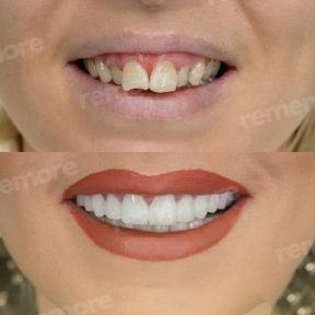 Vorher-nachher-Ergebnis No-Prep-Veneers bei Memorial Şişli Hospital, verbesserte Ästhetik