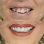 Vorher-nachher-Ergebnis No-Prep-Veneers bei Memorial Şişli Hospital, verbesserte Ästhetik