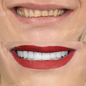 Vorher-nachher-Ergebnis No-Prep-Veneers bei Memorial Şişli Hospital, sichtbare Smile-Verwandlung