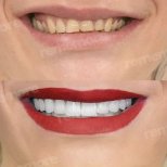 Vorher-nachher-Ergebnis No-Prep-Veneers bei Memorial Şişli Hospital, sichtbare Smile-Verwandlung