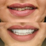 Vorher-nachher-Ergebnis No-Prep-Veneers bei Memorial Şişli Hospital, Lächeln-Transformation